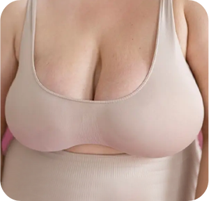 Thu gọn phì đại